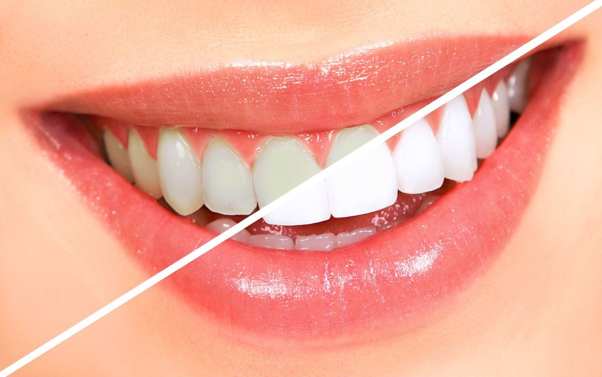 حقائق عن تبييض الاسنان بالبلازما