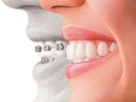 مقوّم الأسنان: ما أهميته؟