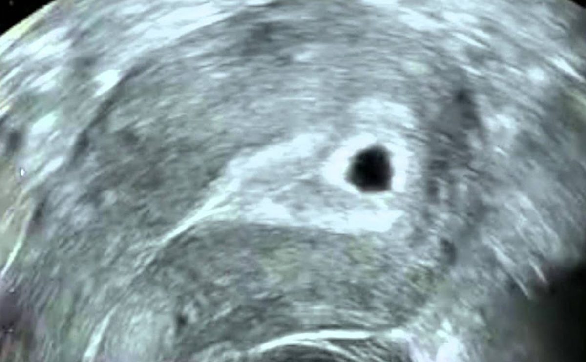 كيف يكون شكل الجنين في الشهر الاول من الحمل بالصور؟