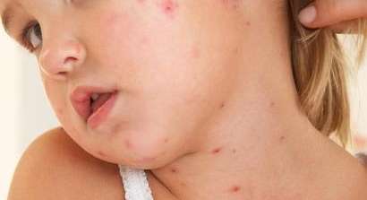 علاج الحصبة عند الأطفال