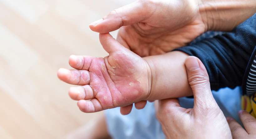 علاج فقاقيع الحروق عند الأطفال
