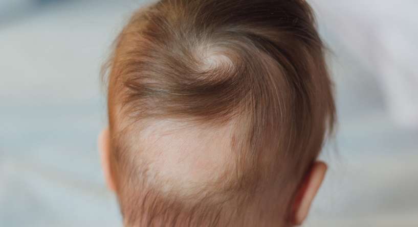 تساقط الشعر عند الاطفال وطرق العلاج