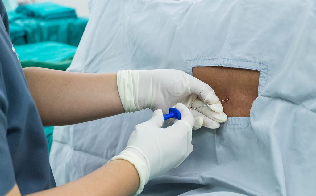 ممرضة تضع إبرة الظهر للحامل قبل الولادة