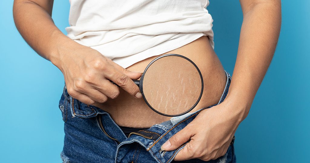 علامات تمدد جلد البطن بسبب الحمل والولادة