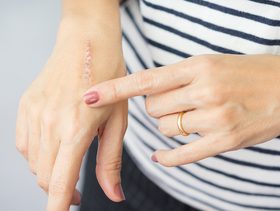 كيفية تنظيف الحروق