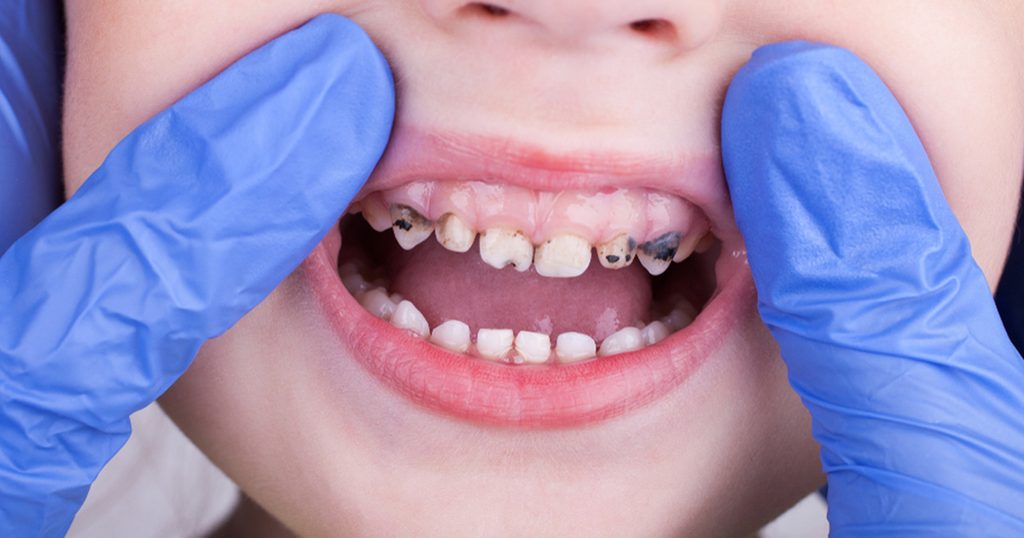 اكتشفي أبرز مسببات تسوس أسنان الأطفال