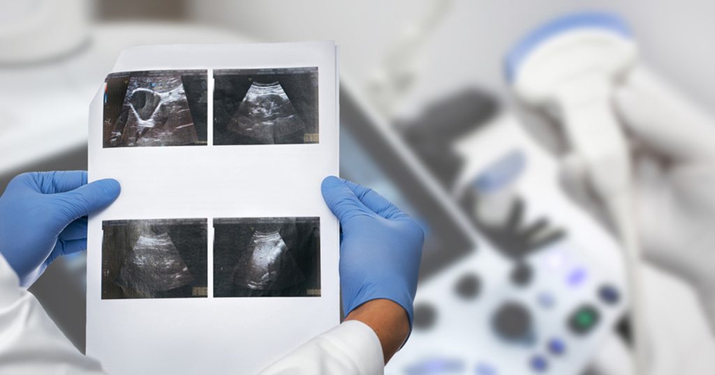 خطوات فحص المرارة بالسونار بالتفاصيل