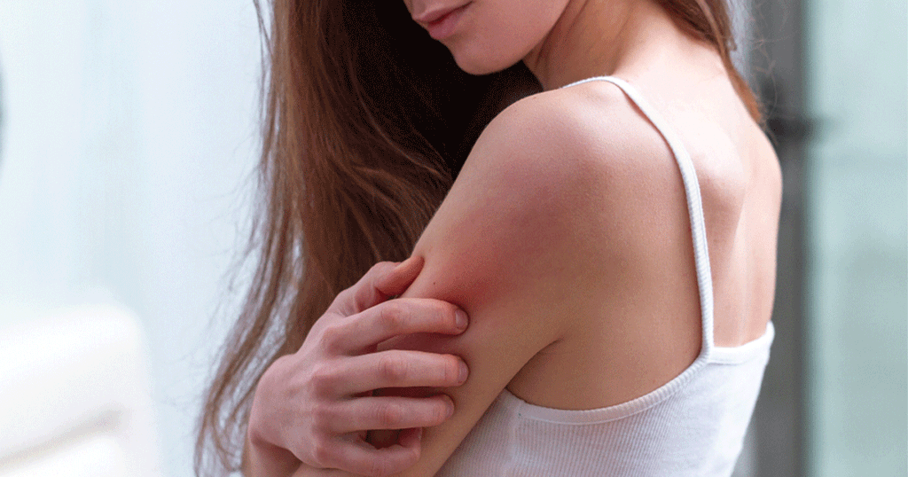 أسرع علاج نهائي للحكّة والحساسية