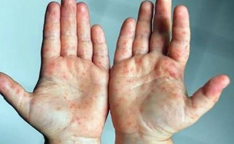 وزارة الصحة السعودية تُقدم نصائح توعوية عن متلازمة اليد والقدم والفم