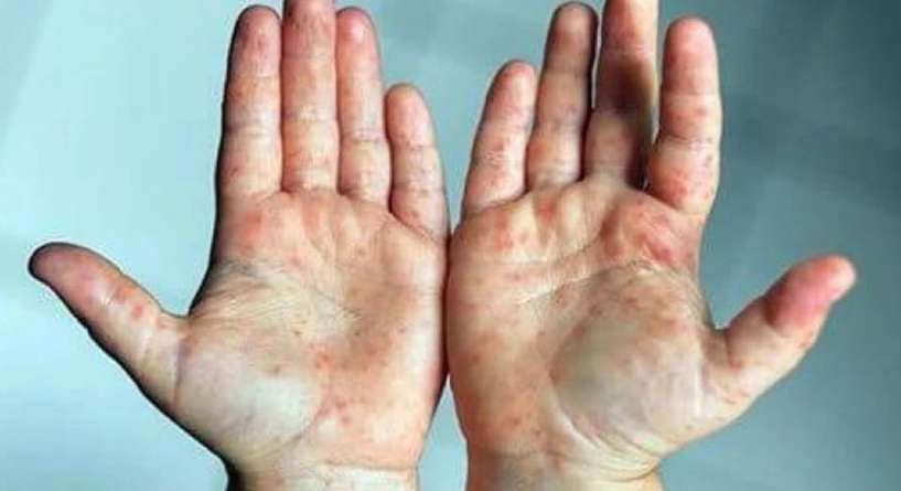 وزارة الصحة السعودية تُقدم نصائح توعوية عن متلازمة اليد والقدم والفم