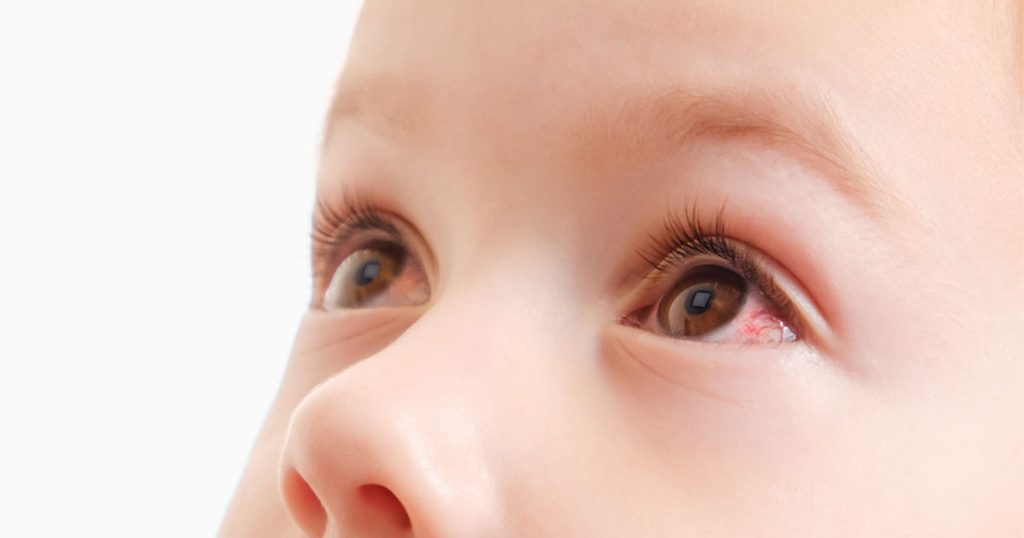 علاج التهاب عيون الأطفال