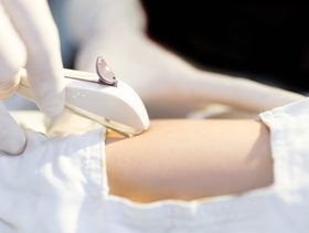 فعالية شريحة منع الحمل