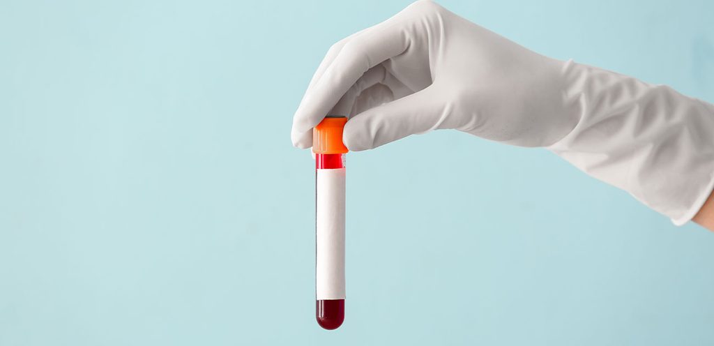 الشروط التي يجب توفيرها قبل إجراء فحص البرولاكتين