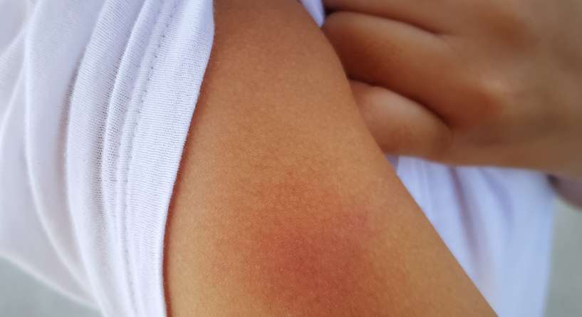 أسباب طفح جلدي بعد الحرارة عند الكبار وعوارضه