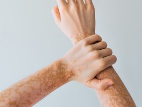 تجربتي مع كريم بروتوبيك للبهاق