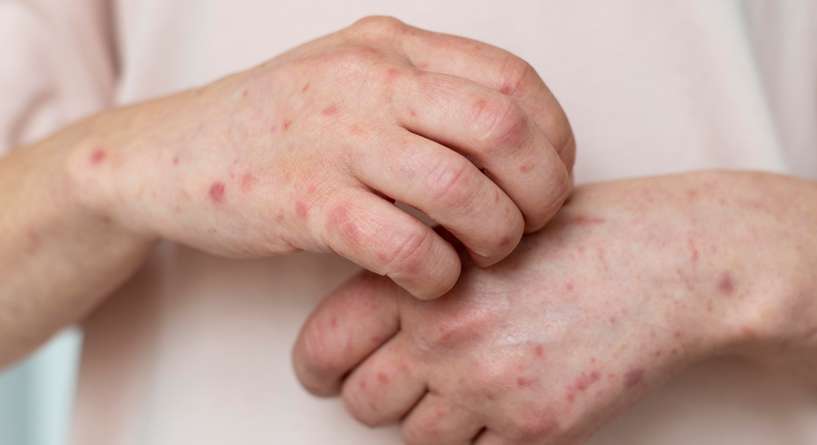 أطباء الإمارات يحذرون المواطنين من الإصابة بجدري الماء مع اقتراب فصل الصيف