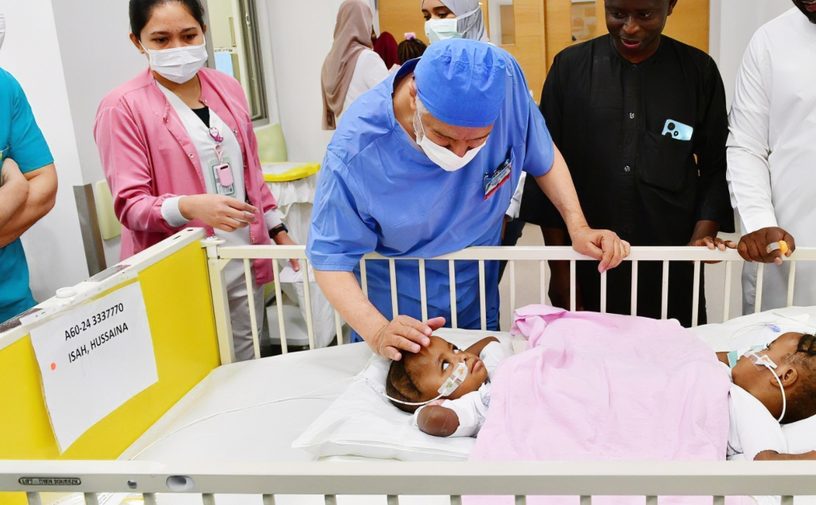 عملية فصل التوأم السيامي النيجيري في الرياض تكلل بالنجاح
