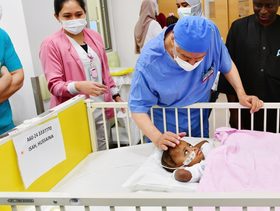 عملية فصل التوأم السيامي النيجيري في الرياض تكلل بالنجاح