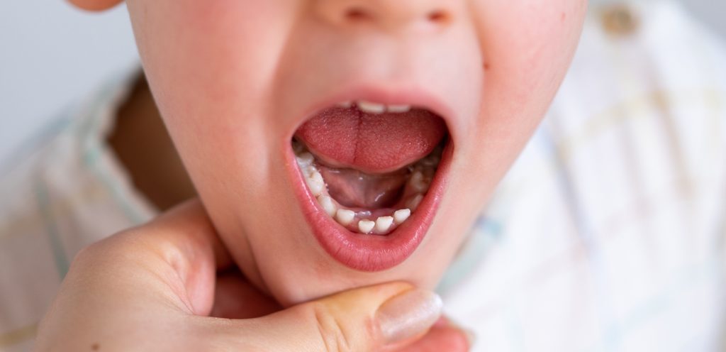 مشاكل الأسنان عند الأطفال