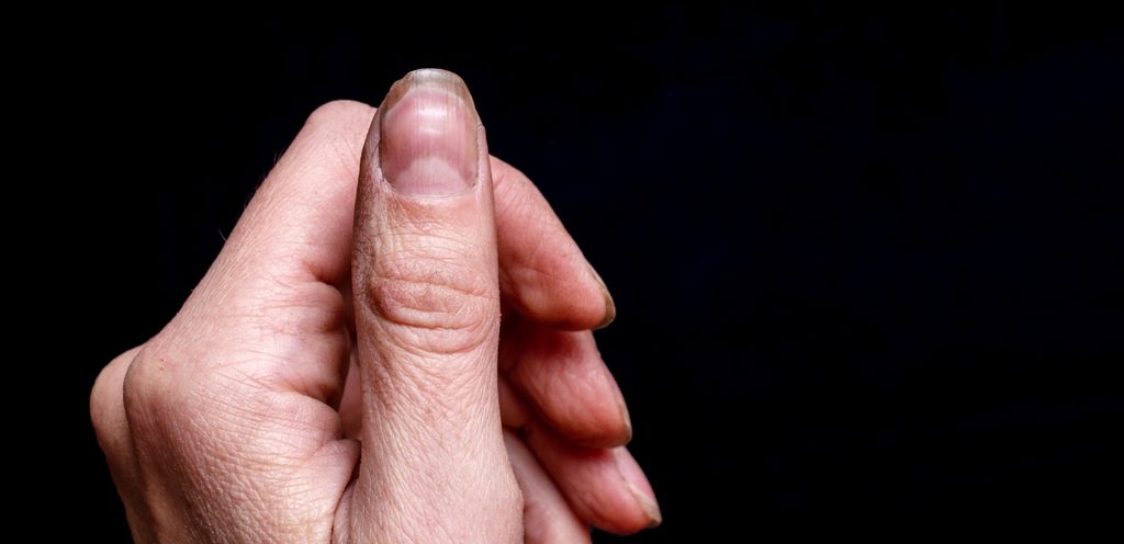 أظافر هشة وبنية اللون