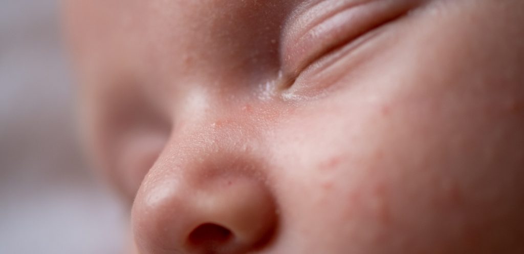 رضيع يعاني من حبوب صغيرة على وجهه