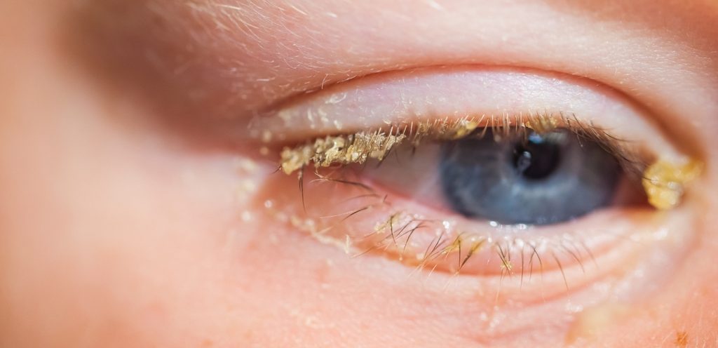 رمد العين عند الأطفال