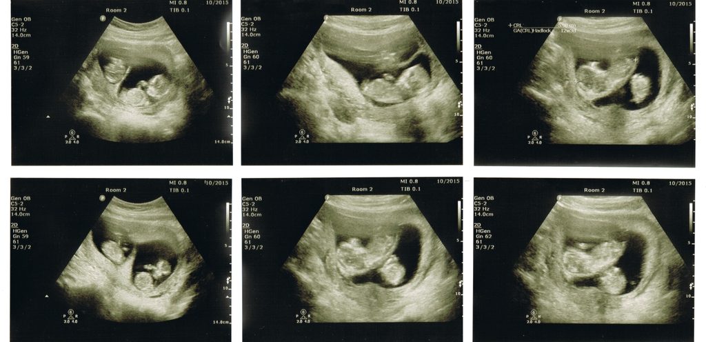 صورة لتوأم جنين