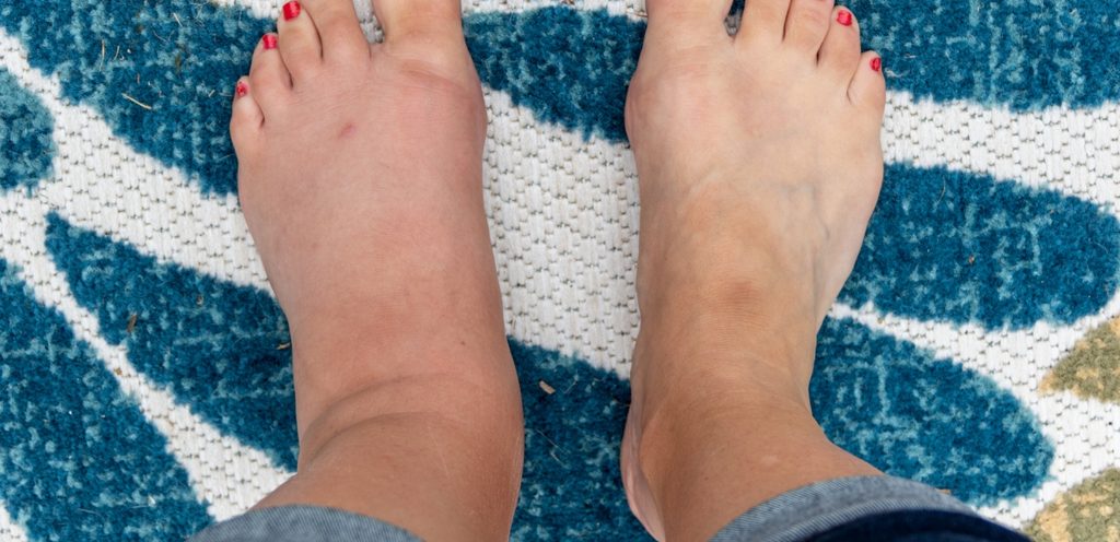 قدميين متورمتين