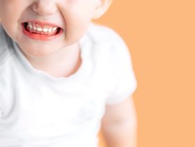 علاج تسوس أسنان الأطفال بعمر سنة ونصف