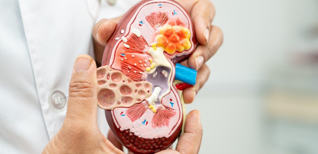 طبيب يمسك مجسّم كلى