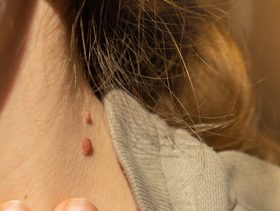 سيدة تعاني من الزوائد الجلدية على العنق