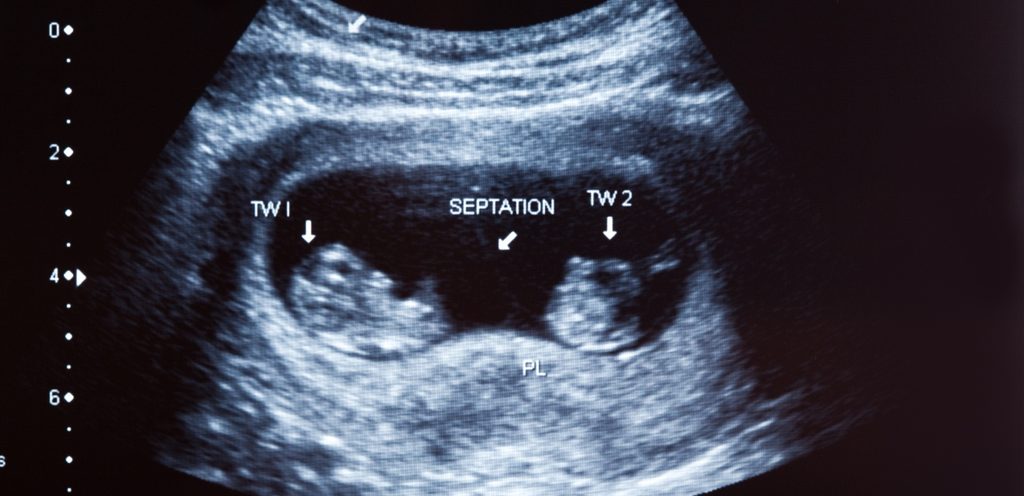 صورة بالموجات فوق الصوتية للتوأم