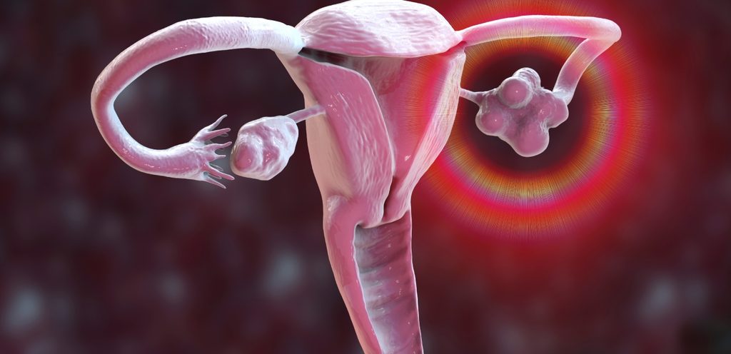 صورة تمثيلية تظهر الكيس على المبيض