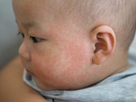 طفل يعاني من مرض كاواساكي