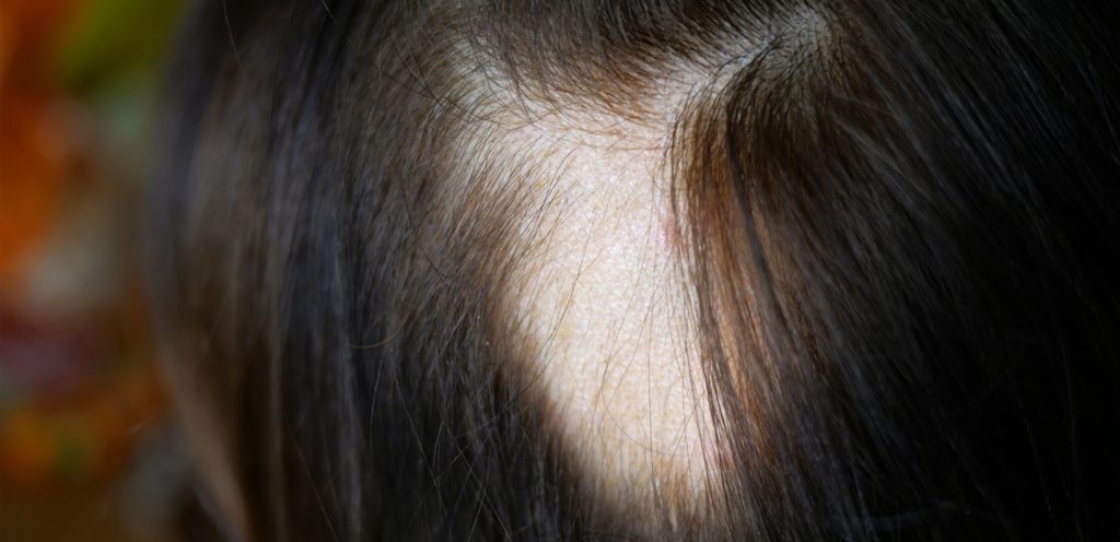 بقعة خالية من الشعر في الرأس