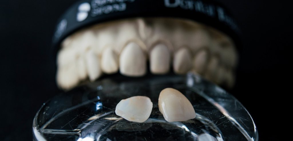 مجسّم أسنان مع أسنان ساقطة