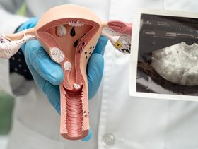 هل تكيسات المبايض تمنع الحمل