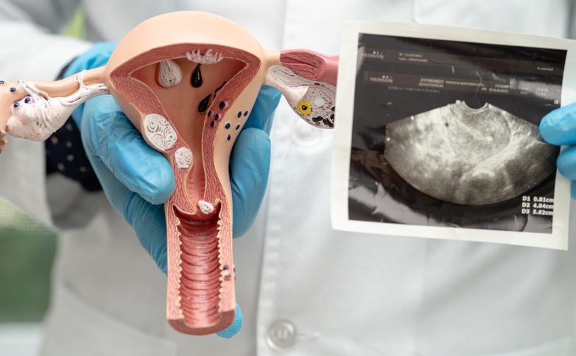 هل تكيسات المبايض تمنع الحمل