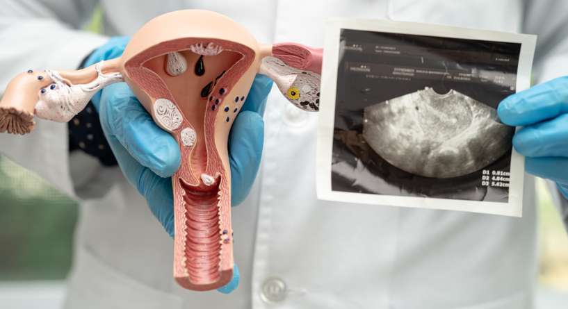 هل تكيسات المبايض تمنع الحمل