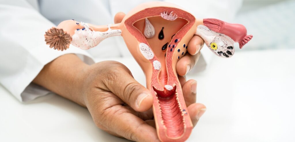 طبيب يمسك مجسّم للرحم