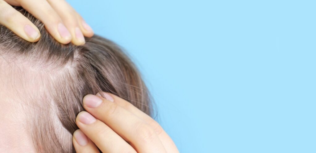 فتاة تعاني من فراغات في الشعر