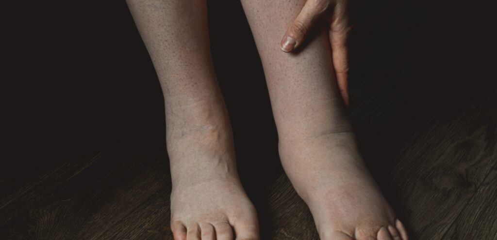 امرأة تعاني من تورم القدمين