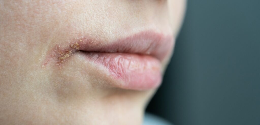 امرأة تعاني من جفاف في الشفاه