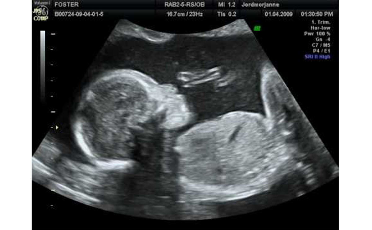 नर भ्रूण का विकास किस महीने में होता है?