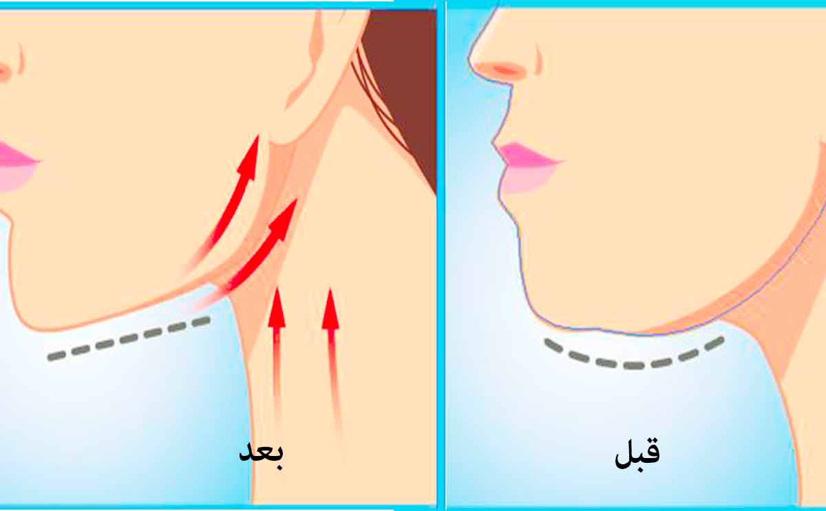 حيلة الشريط اللاصق لشد الرقبة وتنحيفها